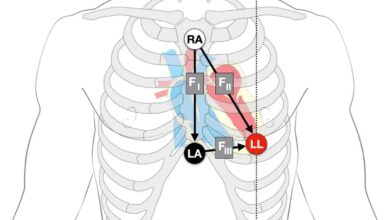 leads on ecg
